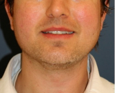Feel Beautiful - Chin Implant 205 - After Photo
